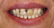 Porcelain-Crowns-Before-Image