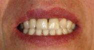 Porcelain-Crowns-After-Image